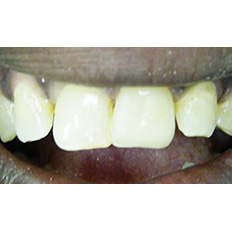 Detail of aligned teeth